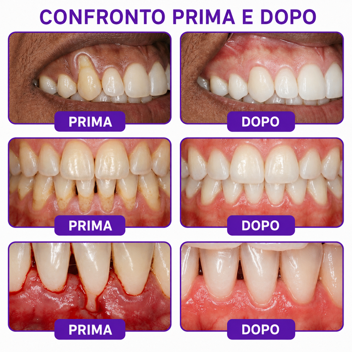 🔑💴GLIMMERLY® VioCore: dentifricio al veleno d'ape per il trattamento della gengivite e della parodontite