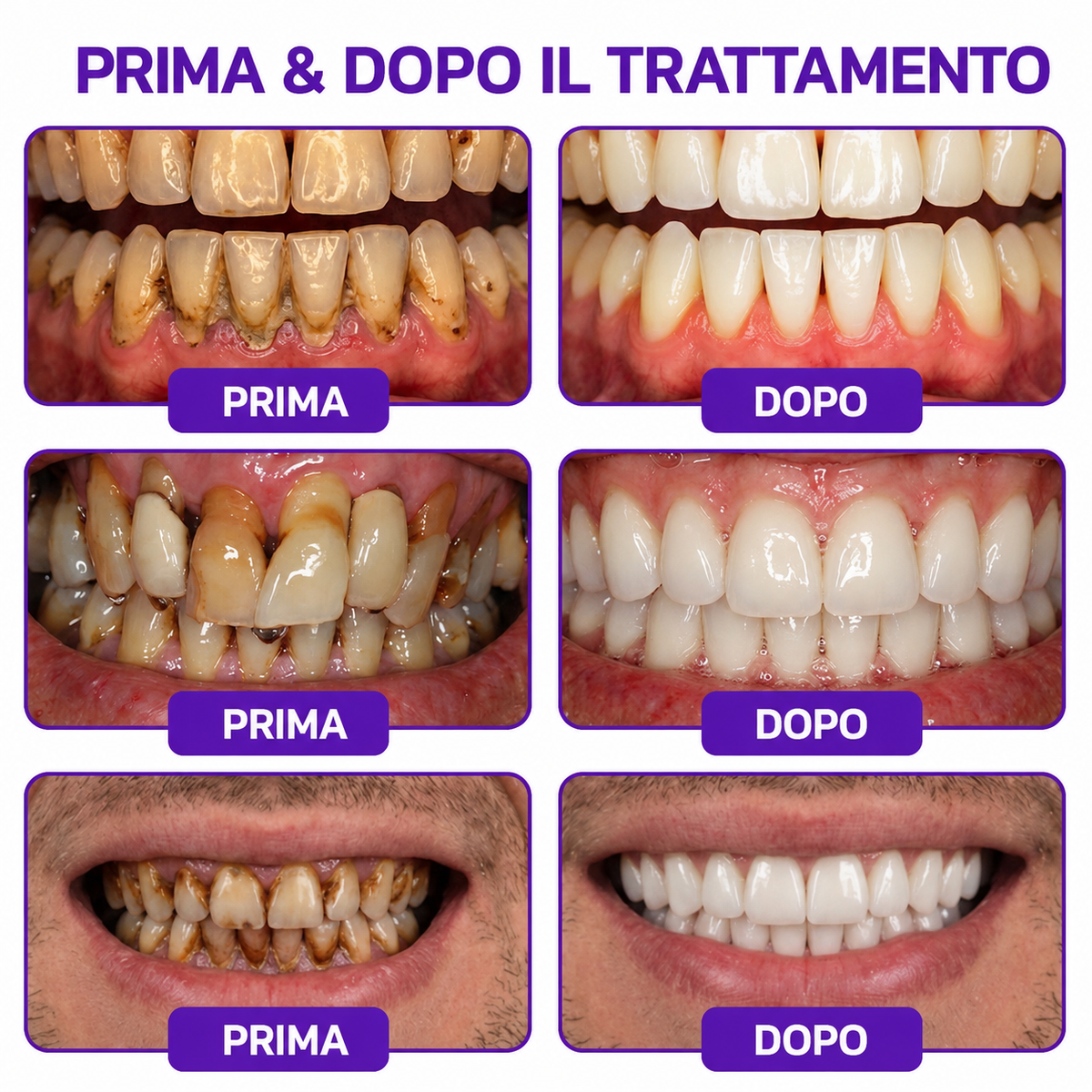 🔑💴GLIMMERLY® VioCore: dentifricio al veleno d'ape per il trattamento della gengivite e della parodontite