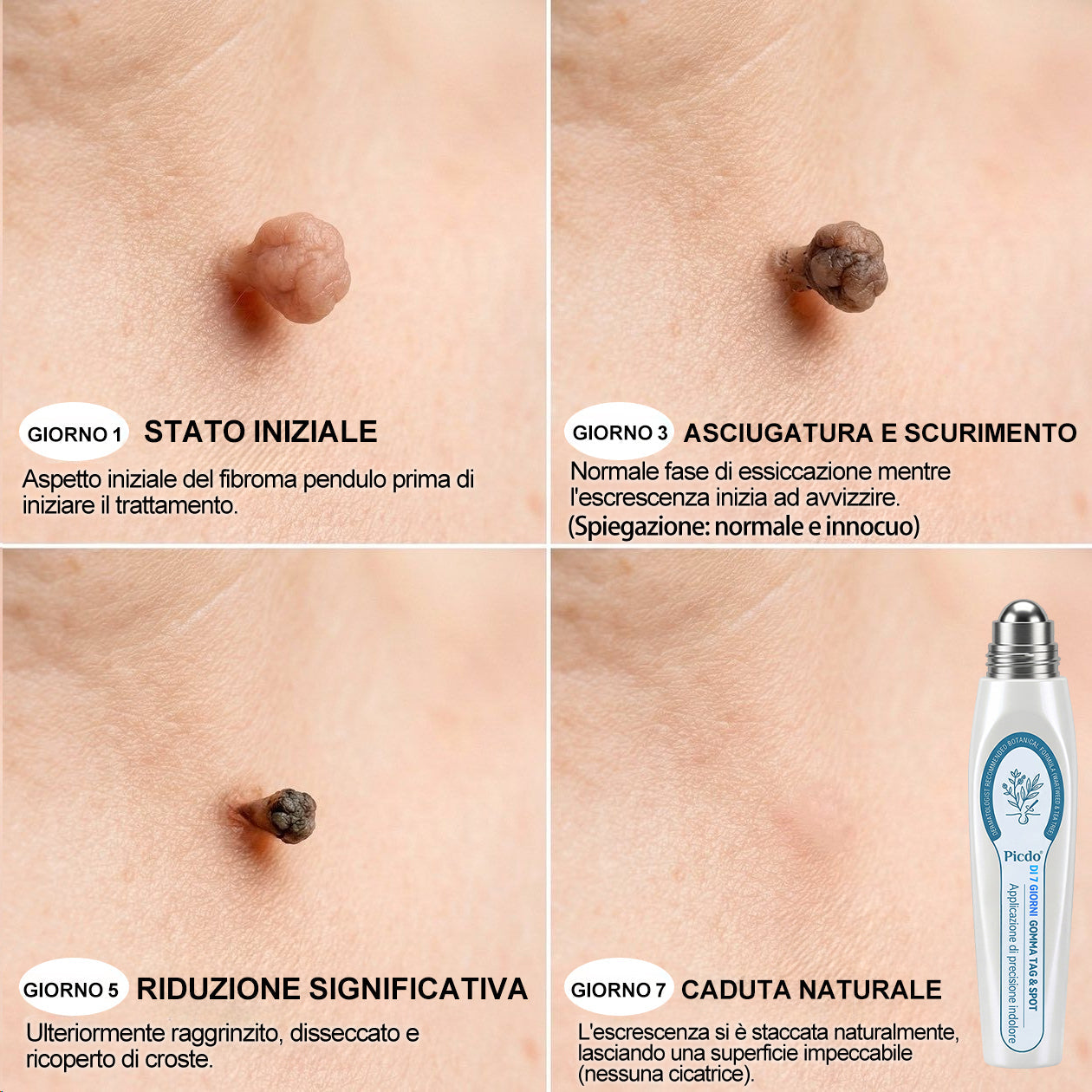 𝐏i𝐜𝐝o® 𝐃𝐢 𝟕 𝐠𝐢𝐨𝐫𝐧𝐢 𝐆𝐨𝐦𝐦𝐚 𝐓𝐚𝐠 & 𝐒𝐩𝐨𝐭(Roll-on Zero Dolore, Zero Cicatrici)💪